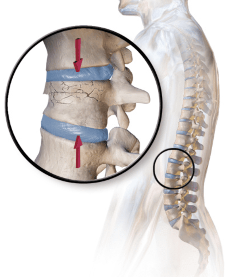 Back Pain Kyphoplasty Fracture Los Angeles San Diego