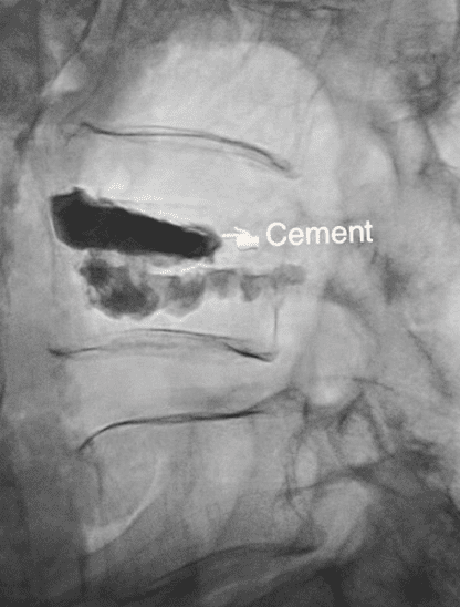 Kyphoplasty Back Pain Doctor Los Angeles