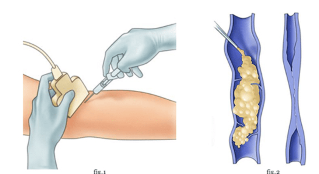 Spider Vein Sclerotherapy Laser Los Angeles Doctor San Diego 