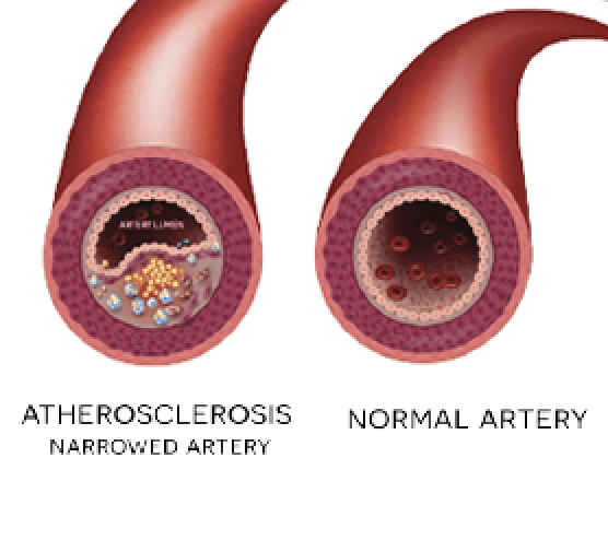 peripheral arterial disease