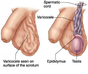 Varicocele Embolization Los Angeles San Diego Orange County California Doctor