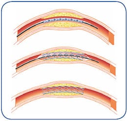 leg pain angioplasty stent los Angeles san diego