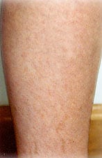 Spider Vein Sclerotherapy Laser Los Angeles Doctor San Diego 