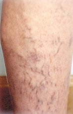 Spider Vein Sclerotherapy Laser Los Angeles Doctor San Diego 