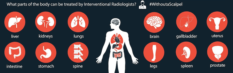 Interventional Radiology