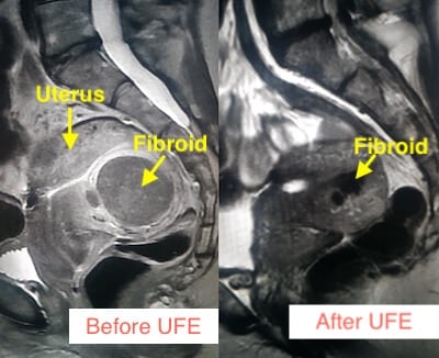 before and after fibroid treatment los angeles