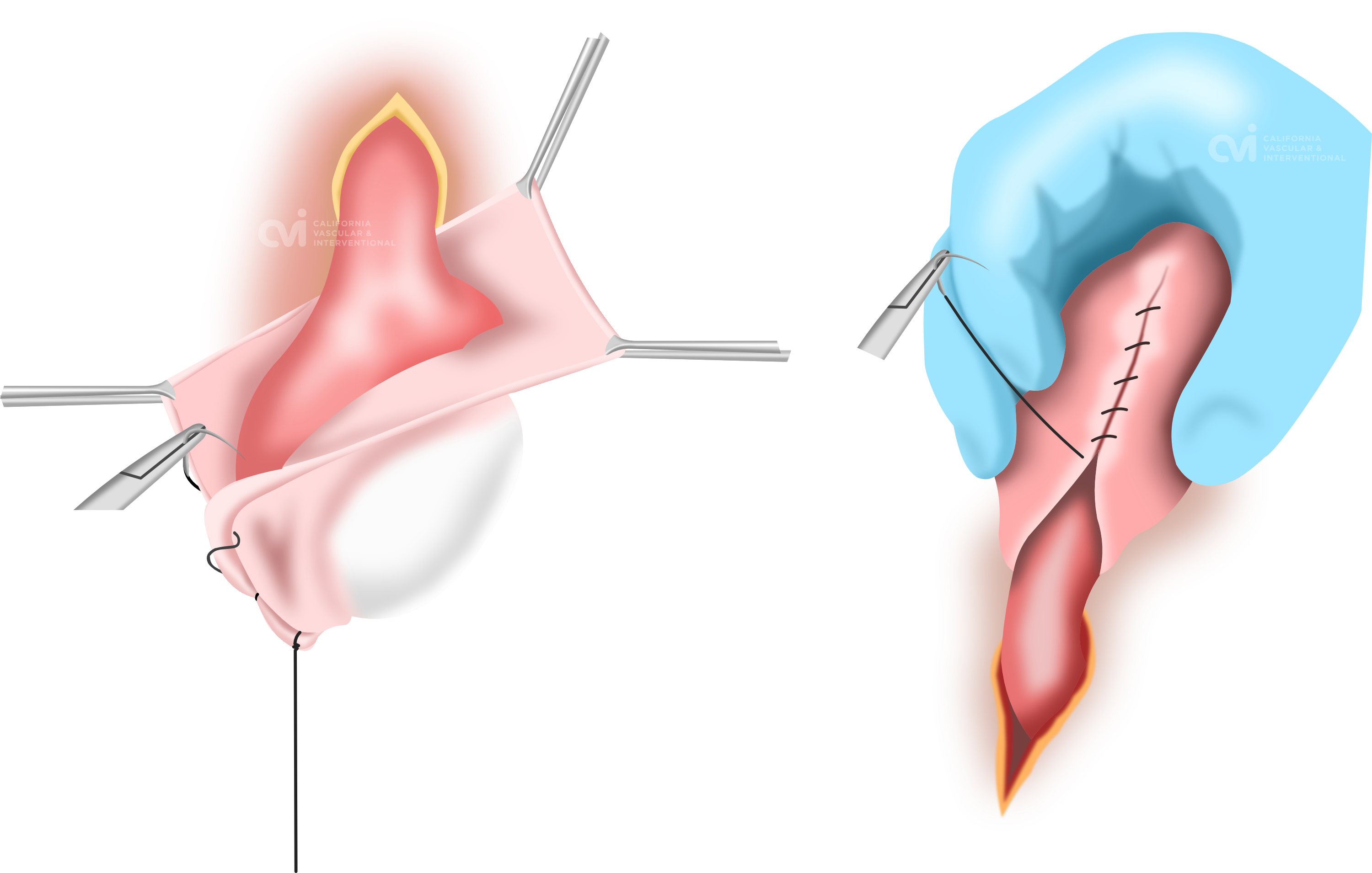 Surgical Hydrocelectomy illustration for hydrocele treatment doctor, Los Angeles, California, Cavascular.com