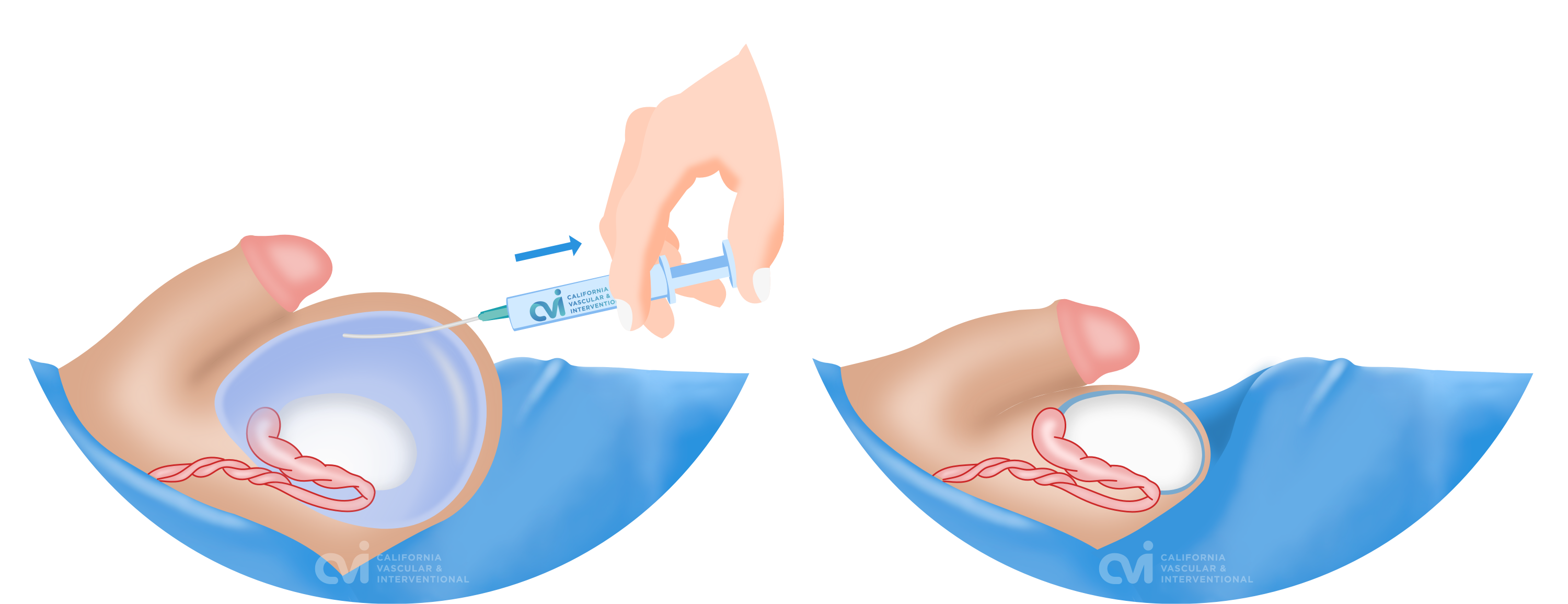 scrotal hydrocele aspiration sclerotherapy los angeles