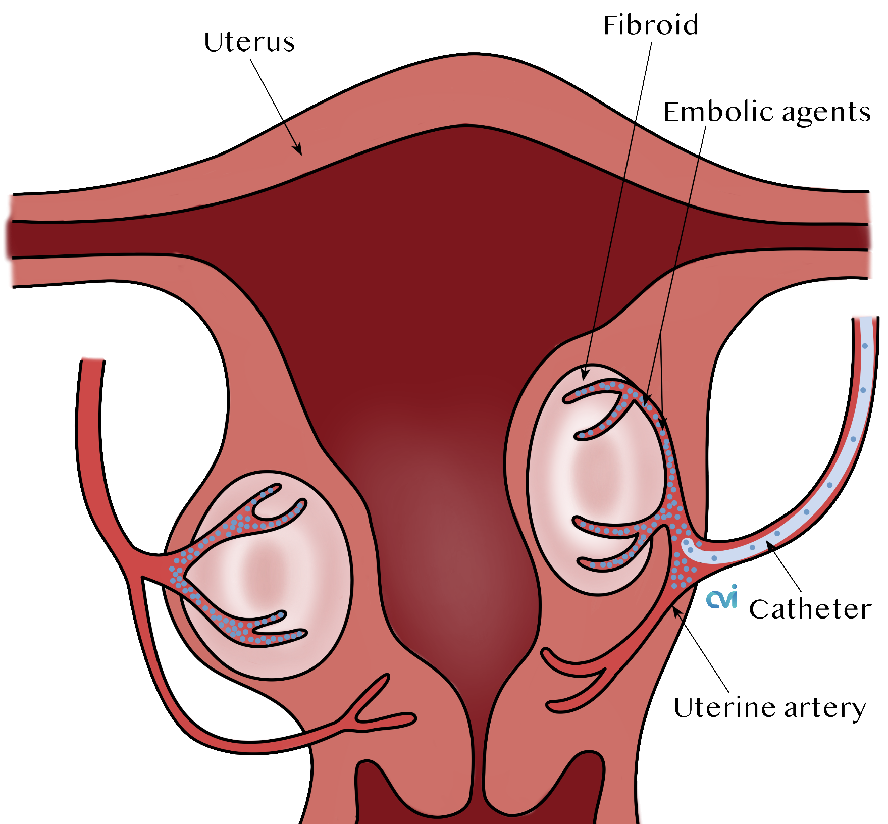 los angeles fibroid specialist embolization beads 