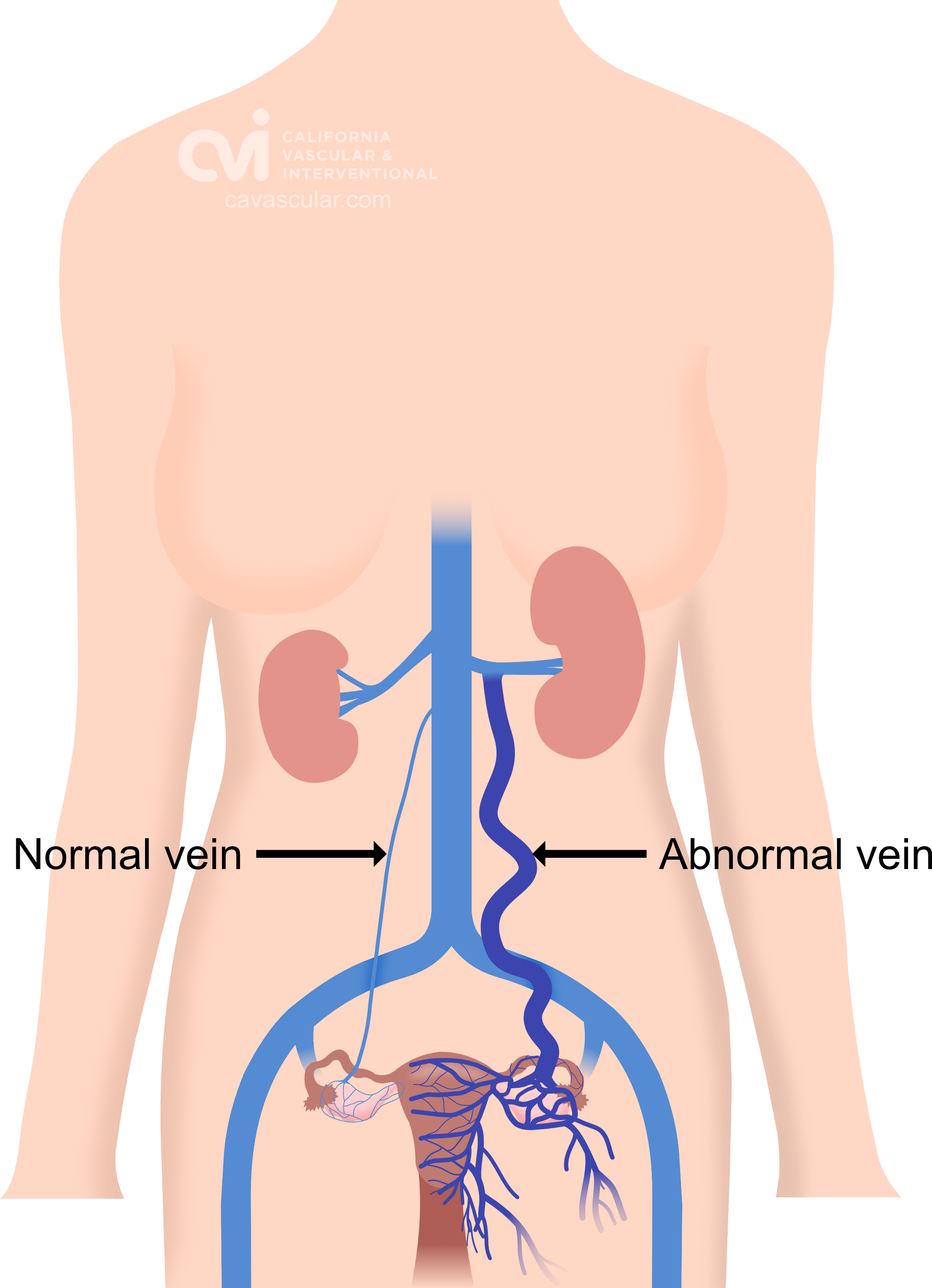 pelvic congestion syndrome illustration left sided abnormal blood flow www.cavascular.com