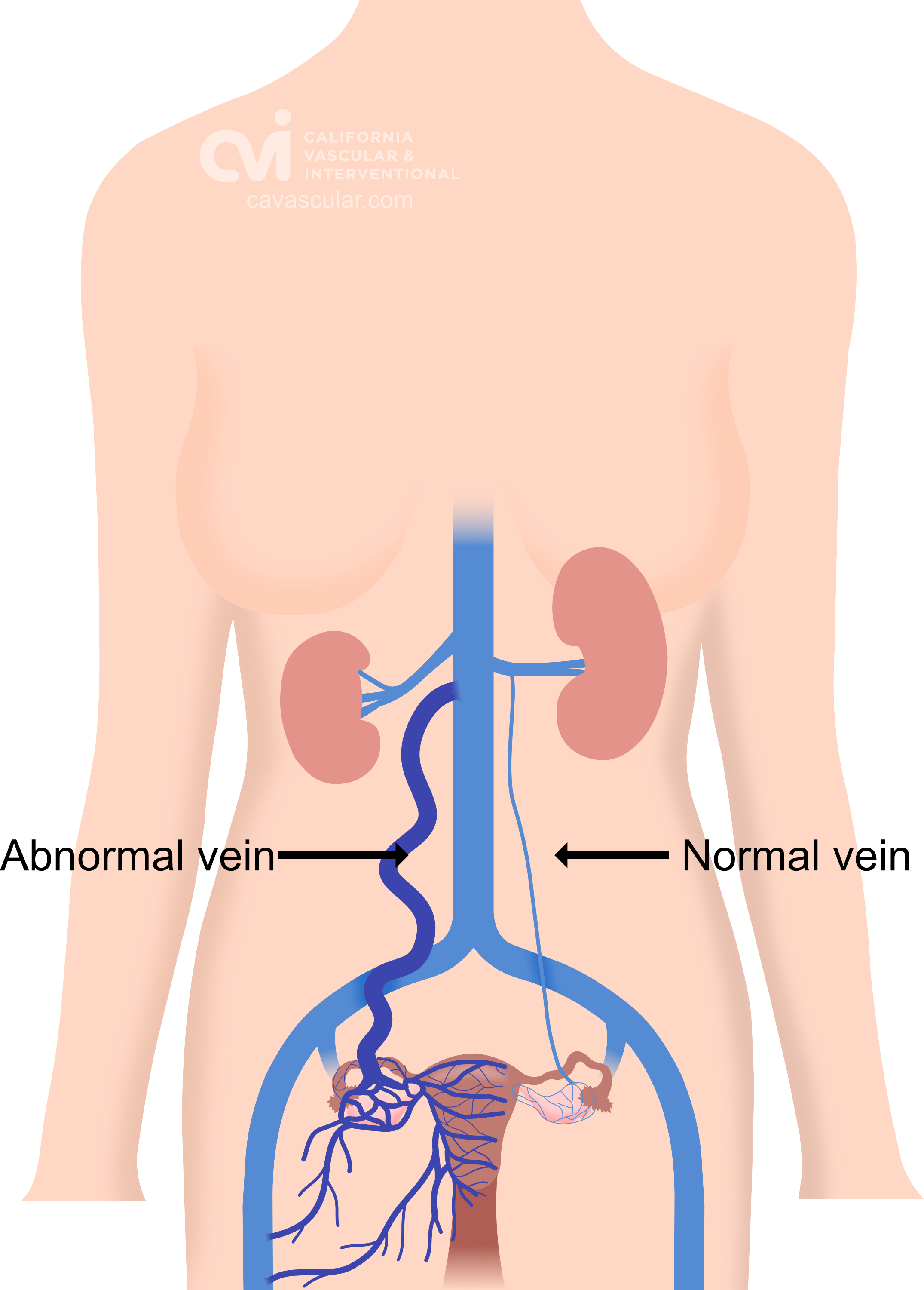 vpelvic congestion syndrome illustration left sided abnormal blood flow www.cavascular.com specialist california los angeles doctor interventional radiologist