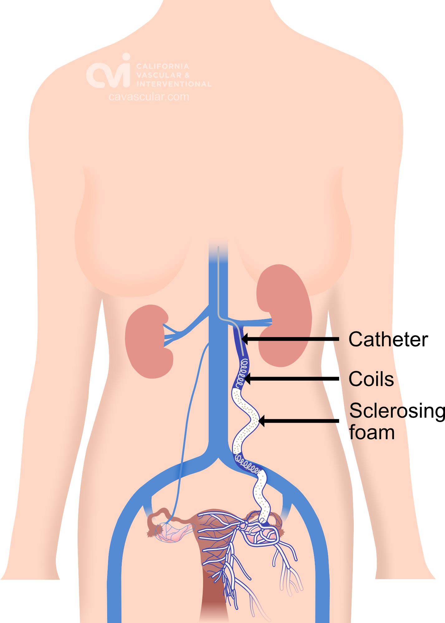 pelvic congestion syndrome post embolization treatment illustration 