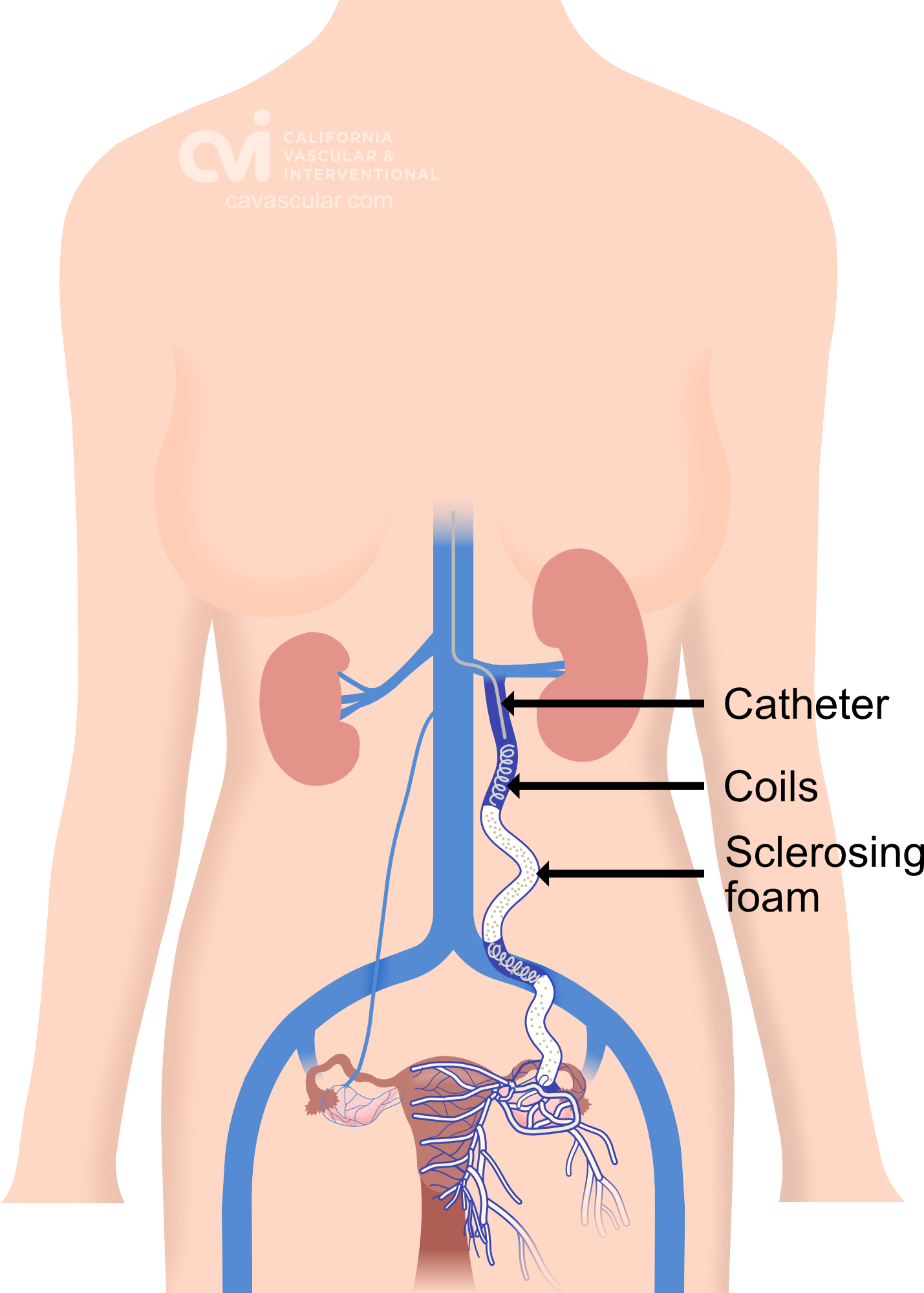 Pelvic Congestion Syndrome - Pelvic Pain Embolization Treatment