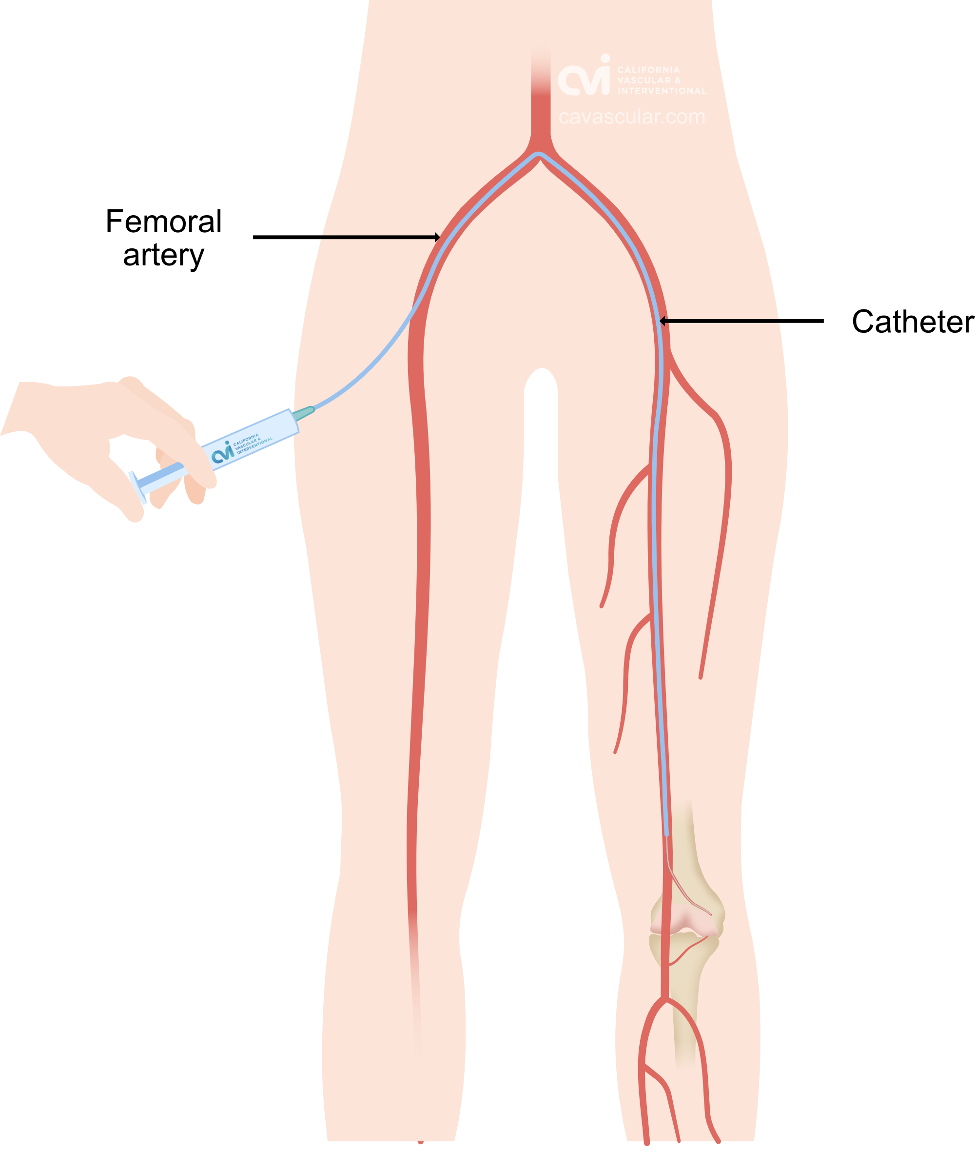 hemarthrosis geniculate artery embolization treatment specialist