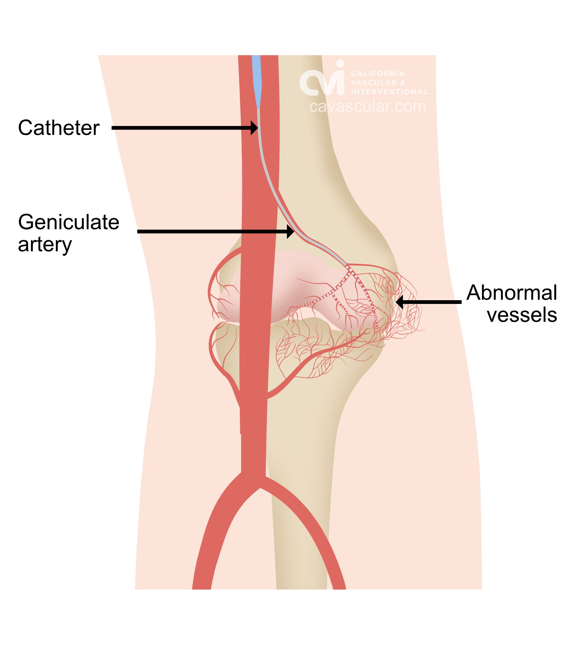 hemarthrosis geniculate artery embolization treatment specialist