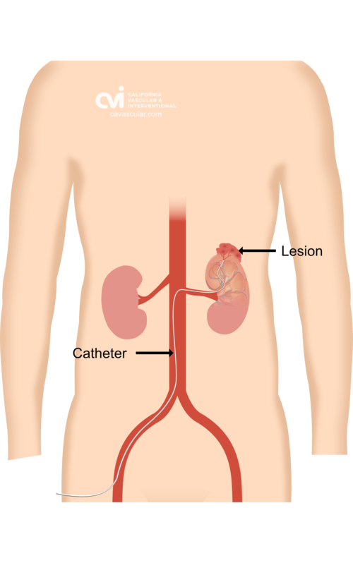 Angiomyolipoma Embolization