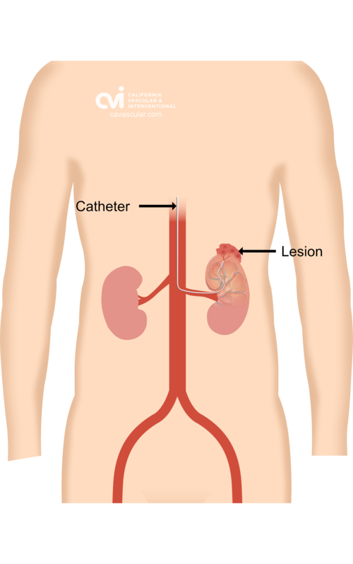 Angiomyolipoma Embolization - 1