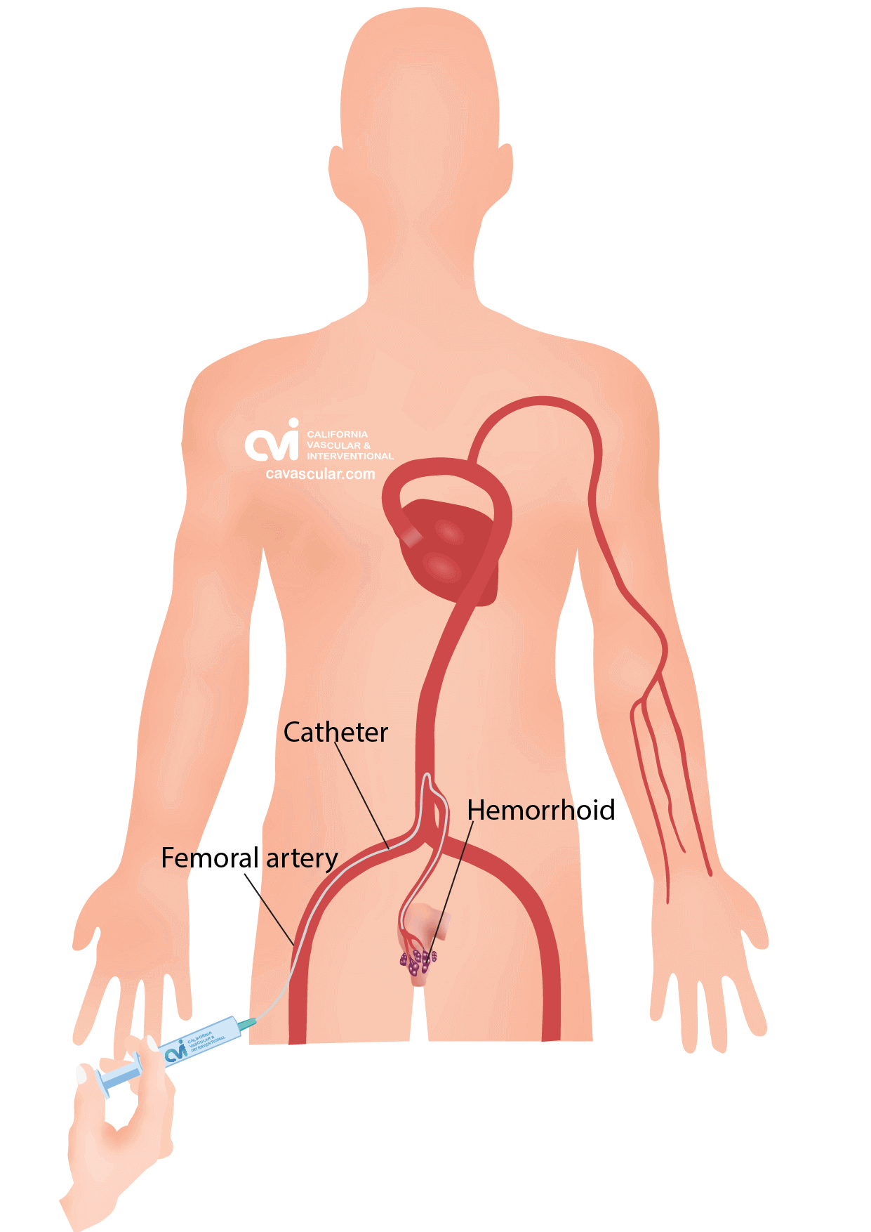 Hemorrhoid Embolization