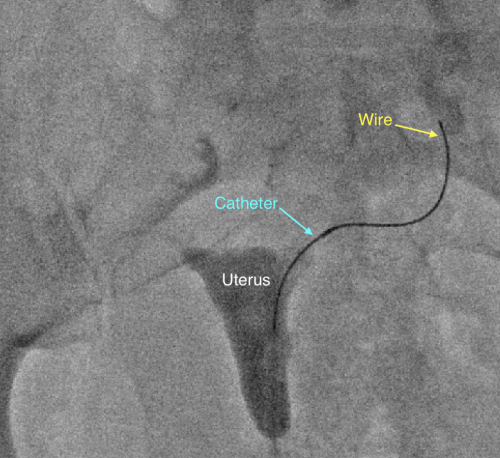 fallopian tube blockage recanalization los angeles california