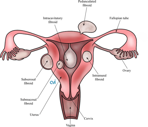 cavascular fibroid treatment los angeles