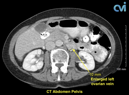 CT Pelvic Venous Congestion Syndrome