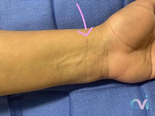 1 week post UAE wrist incisiontop fibroid doctor near me los angeles california