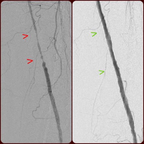 PVD Claudication