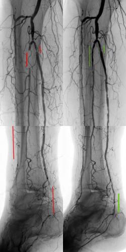 PVD Leg Wound