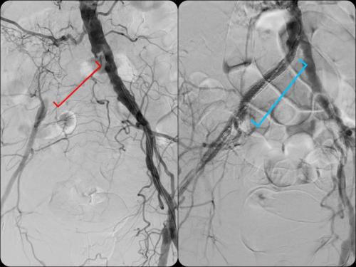 PVD Claudication