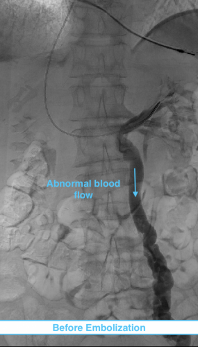 Venogram Pelvic Venous Congestion Syndrome