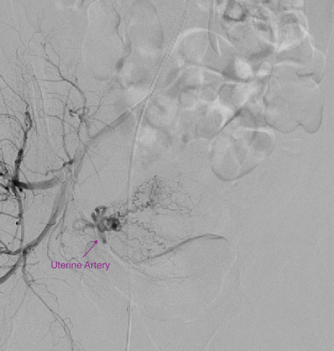 Pelvic angiogram is being performed here to obtain the anatomy on the right and identify the uterine artery.