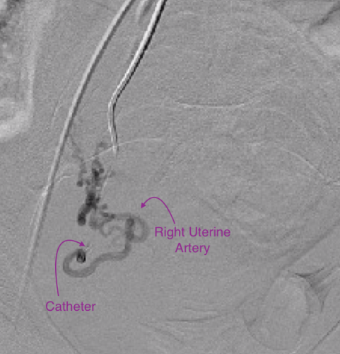 Right Uterine Artery imaging prior to embolization.