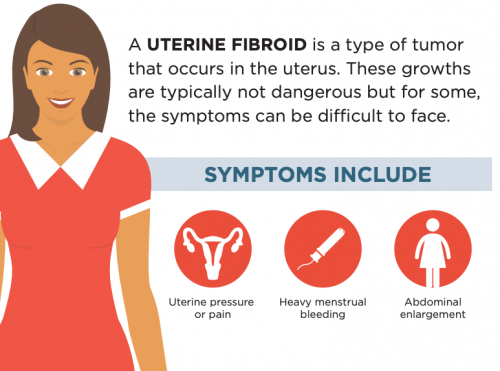 Uterine Fibroid Symptoms