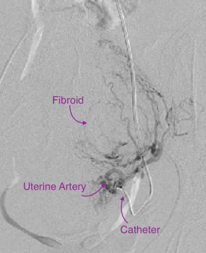 Uterine Artery Embolization 
