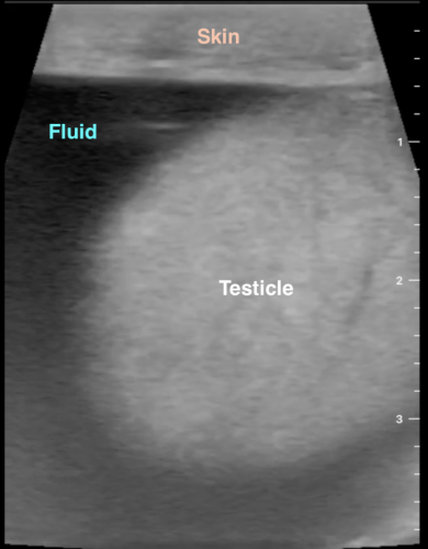 Hydrocele aspiration and sclerotherapy. 