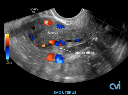 Ultrasound Pelvic Venous Congestion