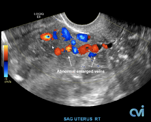 Ultrasound Pelvic Venous Congestion Syndrome