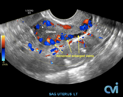 Ultrasound Pelvic Venous Congestion Syndrome
