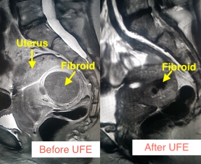 before after uterine fibroid treatment Los Angeles center