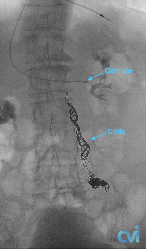 Venogram Pelvic Venous Congestion Syndrome