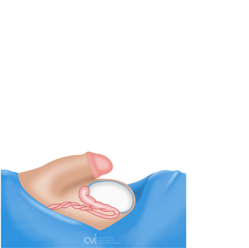 Hydrocele treatment: aspiration and sclerotherapy