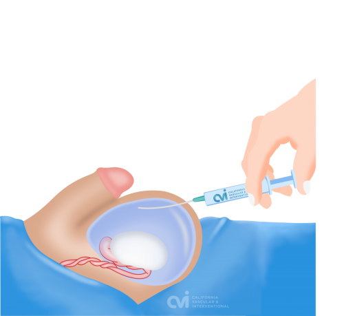 Hydrocele treatment: aspiration and sclerotherapy