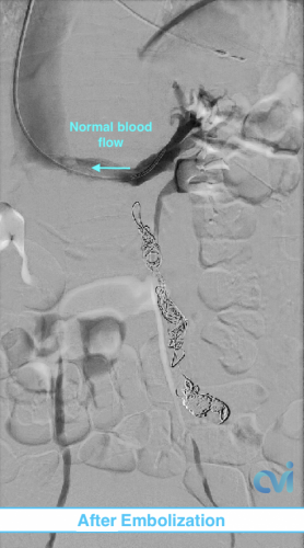 Venogram Pelvic Venous Congestion Syndrome