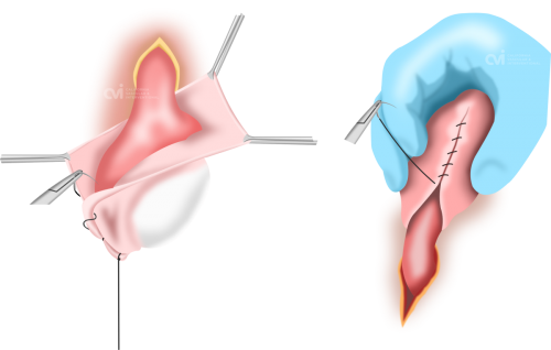 surgical hydrocelectomy