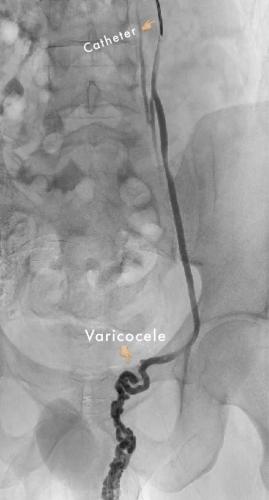 varicocele venogram