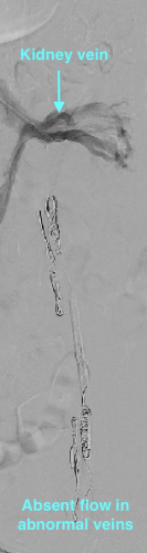 varicocele post embolization